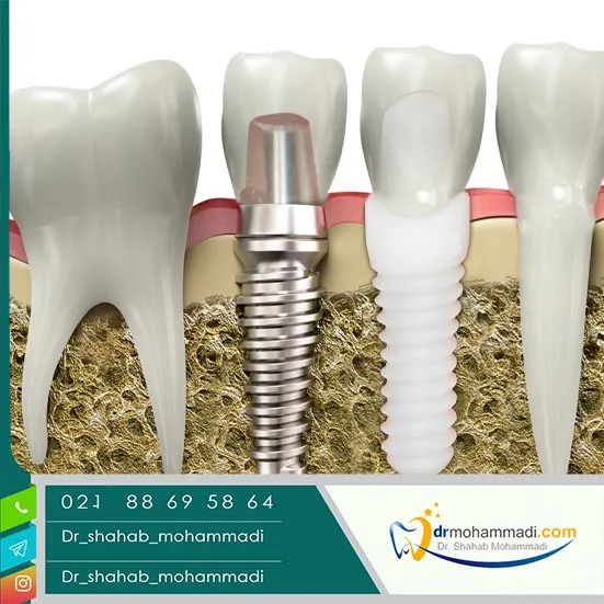 ایمپلنت سرامیکی: راهکار طبیعی و بادوام برای جایگزینی دندان